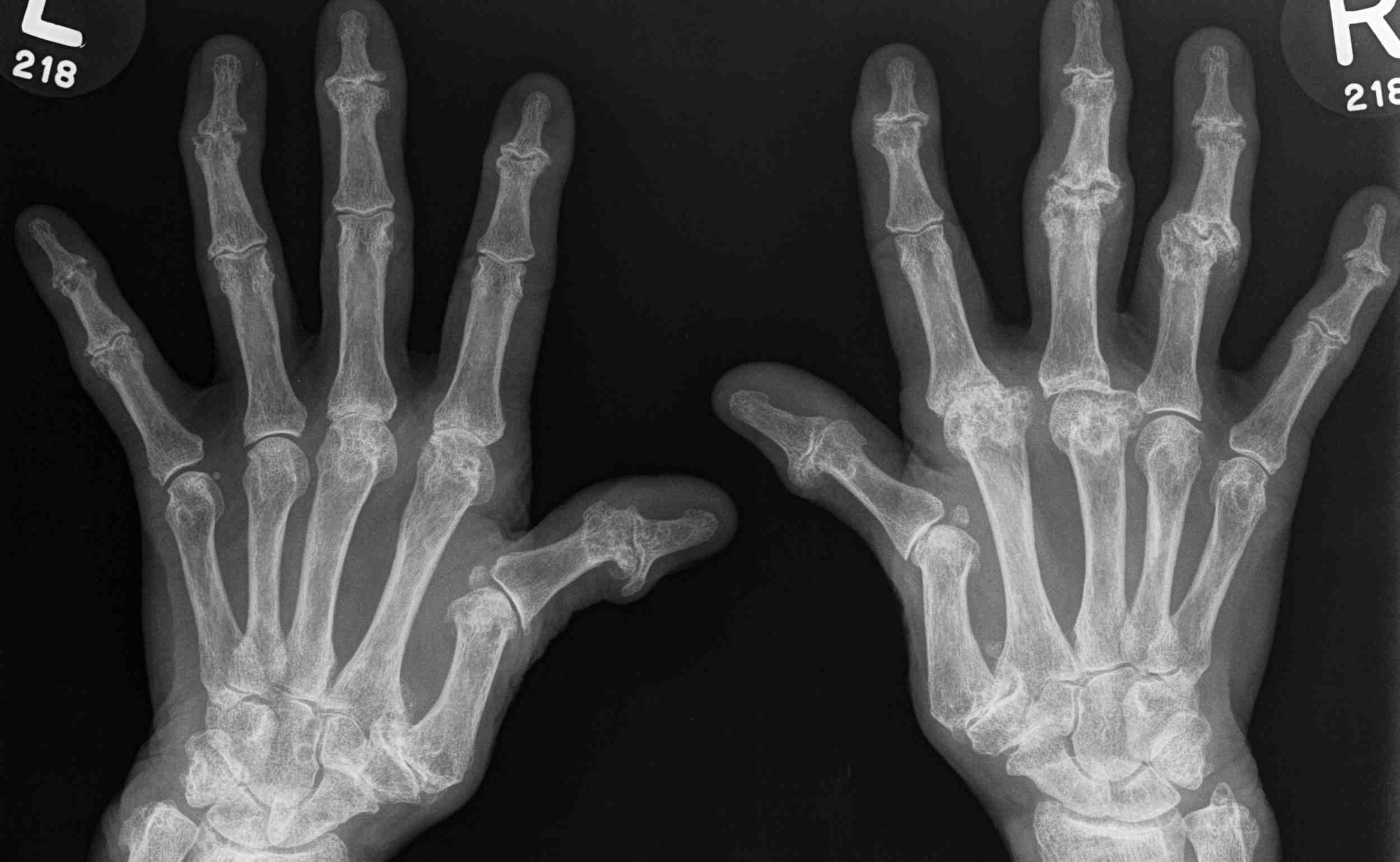 Rheumatoid Hands Xray